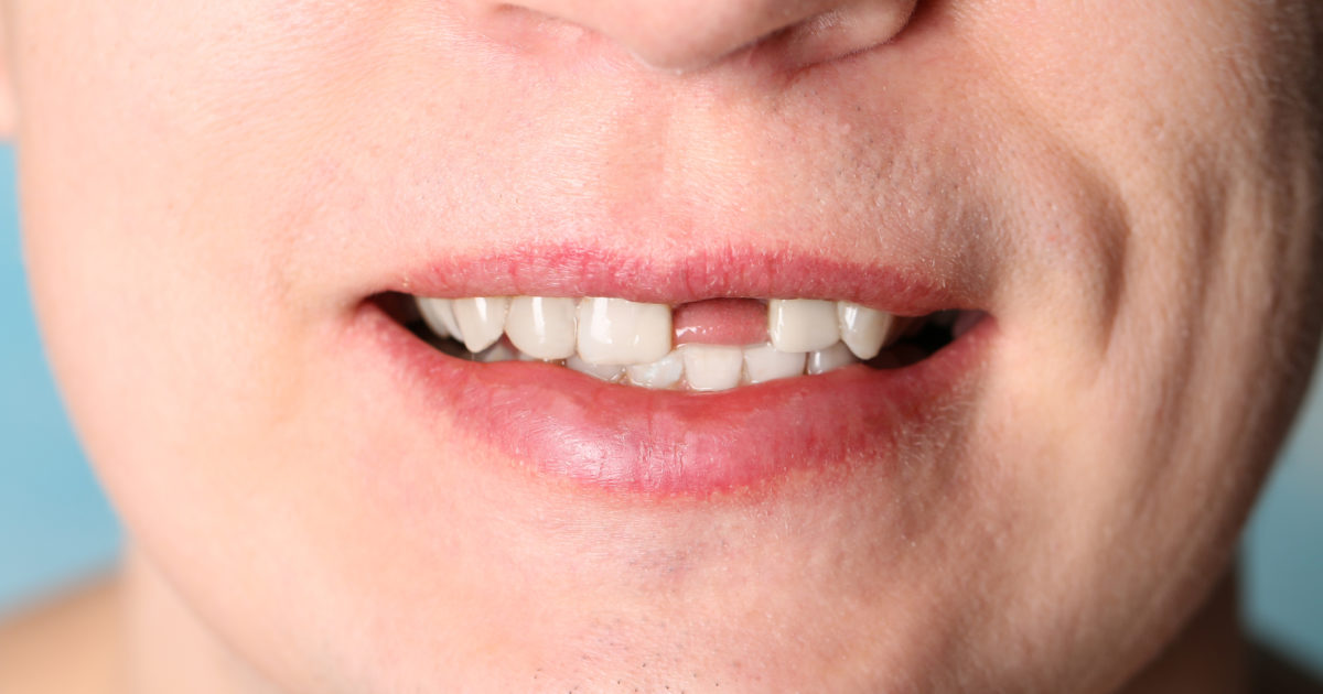 Featured image for “What to Do if a Tooth is Knocked Out”