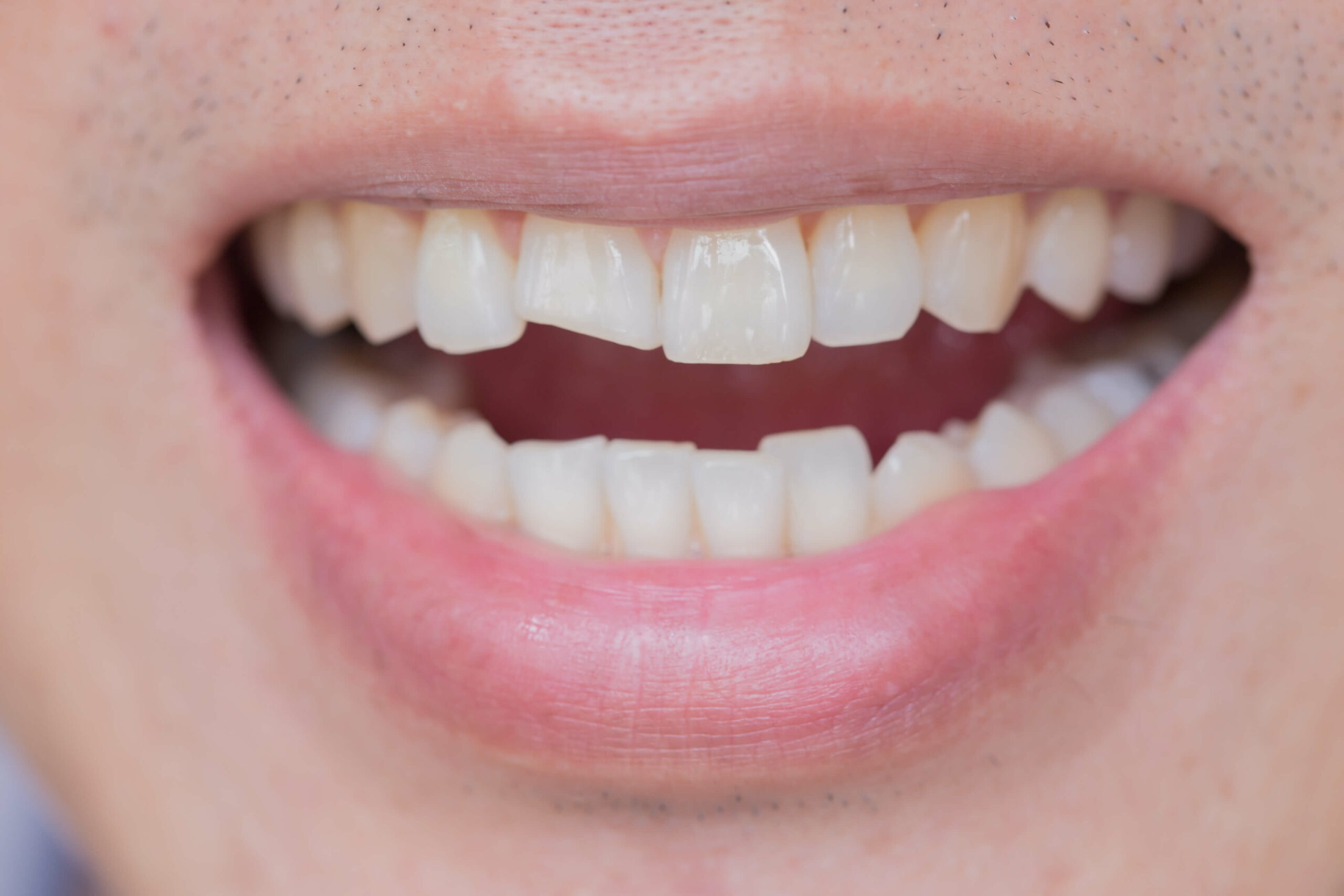 Featured image for “What is Cracked Tooth Syndrome?”