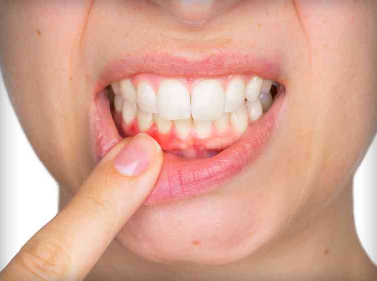 Featured image for “Teenagers and Gum Disease: Everything You Need to Know”