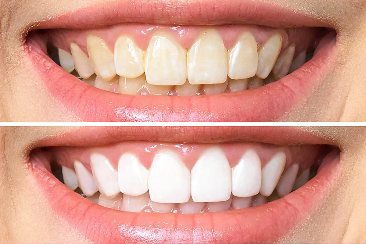 Featured image for “5 Common Questions About Teeth Whitening: Answered by Dentists”