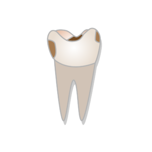 Effects of Pregnancy on Oral Health 1 class ii cavity