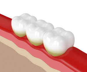 Effects of Pregnancy on Oral Health 2 teeth with plaque and red gums from gingivitis