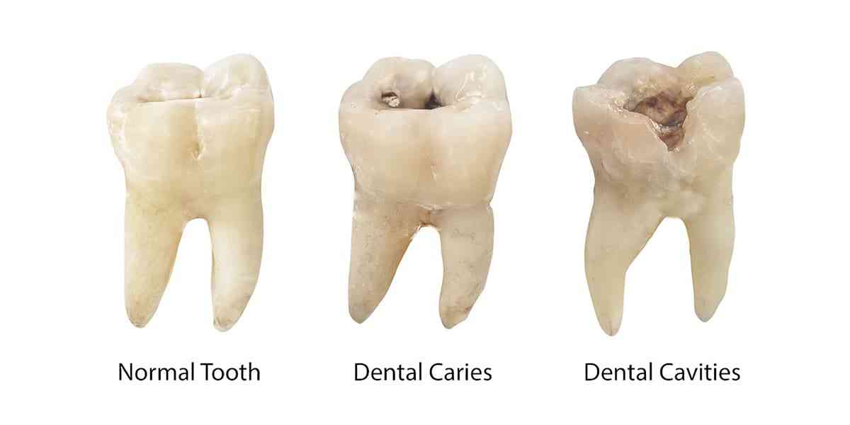 Featured image for “Why Do You Keep Getting Dental Cavities?”